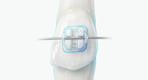 세라믹 교정 장치의 심미적 구현 모습